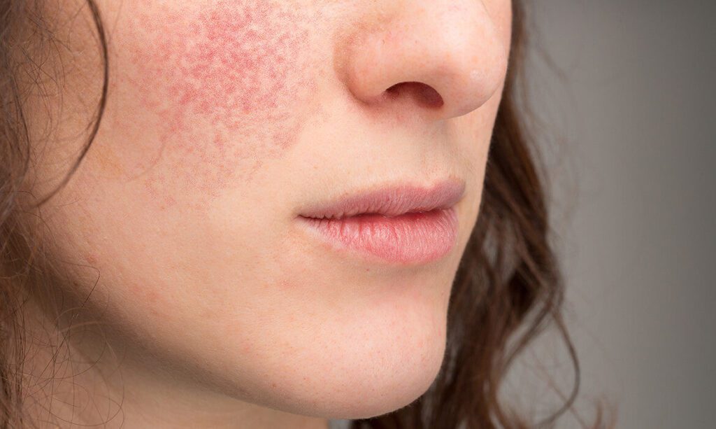 Eczema Symptoms, Triggers, and Management Face Fresh